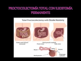 Se retira el colon, el 
recto y el ano 
Después se crea 
una ileostomía 
permanente 
(abriendo el 
abdomen) 
Se añade una 
bolsa para recoger 
desperdicios 
durante la 
ileostomía 
Este tipo de cirugía ya 
no es muy usada 
el recto contiene 
muchos pólipos y éstos 
no regresen después 
de haber practicado 
una cirugía menor 
 