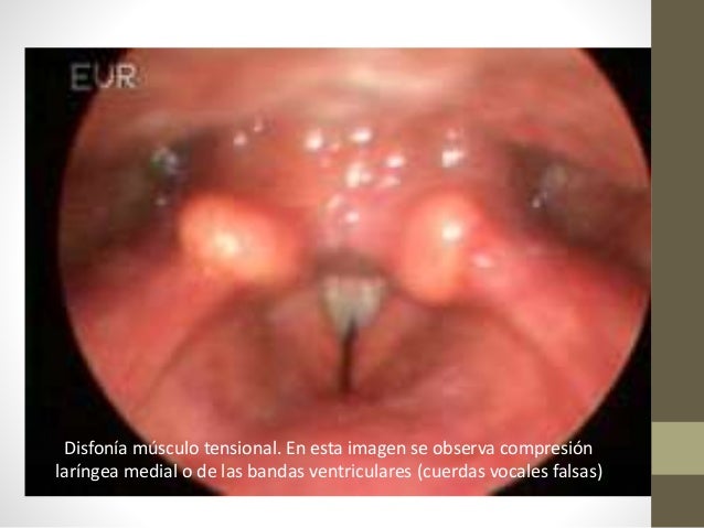 Resultado de imagen para disfonÃa musculotensional