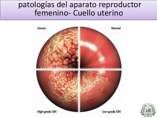 Patologías del aparato reproductor femenino