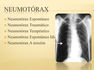 NEUMOTÓRAX 
 Neumotórax Espontáneo 
 Neumotórax Traumático 
 Neumotórax Terapéutico 
 Neumotórax Espontáneo Idiopático 
 Neumotórax A tensión 
 