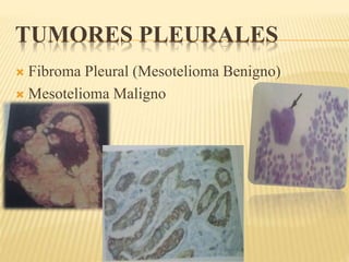 TUMORES PLEURALES 
 Fibroma Pleural (Mesotelioma Benigno) 
 Mesotelioma Maligno 
 