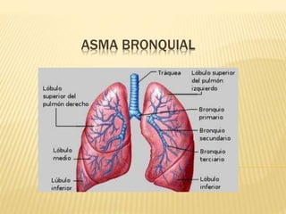 ASMA BRONQUIAL 
 
