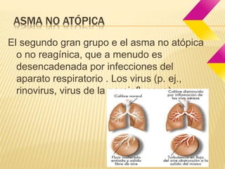 ASMA NO ATÓPICA 
El segundo gran grupo e el asma no atópica 
o no reagínica, que a menudo es 
desencadenada por infecciones del 
aparato respiratorio . Los virus (p. ej., 
rinovirus, virus de la parainfluenza). 
 