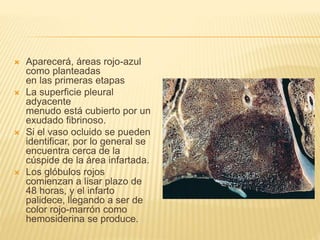  Aparecerá, áreas rojo-azul 
como planteadas 
en las primeras etapas 
 La superficie pleural 
adyacente 
menudo está cubierto por un 
exudado fibrinoso. 
 Si el vaso ocluido se pueden 
identificar, por lo general se 
encuentra cerca de la 
cúspide de la área infartada. 
 Los glóbulos rojos 
comienzan a lisar plazo de 
48 horas, y el infarto 
palidece, llegando a ser de 
color rojo-marrón como 
hemosiderina se produce. 
 