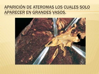 APARICIÓN DE ATEROMAS LOS CUALES SOLO 
APARECER EN GRANDES VASOS. 
 