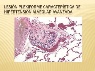 LESIÓN PLEXIFORME CARACTERÍSTICA DE 
HIPERTENSIÓN ALVEOLAR AVANZADA 
 