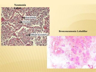 Neumonía 
Lobar 
Bronconeumonía Lobulillar 
 