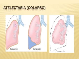 ATELECTASIA (COLAPSO) 
 