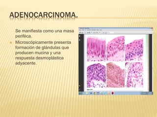 ADENOCARCINOMA. 
Se manifiesta como una masa 
periféca. 
 Microscópicamente presenta 
formación de glándulas que 
producen mucina y una 
respuesta desmoplástica 
adyacente. 
 