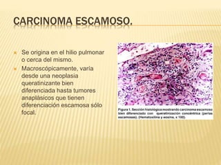 CARCINOMA ESCAMOSO. 
 Se origina en el hilio pulmonar 
o cerca del mismo. 
 Macroscópicamente, varía 
desde una neoplasia 
queratinizante bien 
diferenciada hasta tumores 
anaplásicos que tienen 
diferenciación escamosa sólo 
focal. 
 