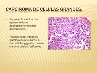 CARCINOMA DE CÉLULAS GRANDES. 
 Representa carcinomas 
epidermoides o 
adenocarcinomas mal 
diferenciados. 
 Pueden haber variantes 
histológicas peculiares. Ej. 
Con células gigantes, células 
claras o células fusiformes. 
 