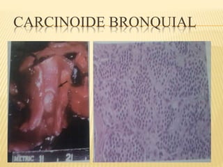 CARCINOIDE BRONQUIAL 
 
