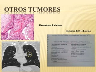 OTROS TUMORES 
Hamartoma Pulmonar 
Tumores del Mediastino 
 