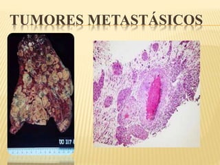 TUMORES METASTÁSICOS 
 