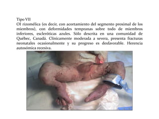 Tipo VII
OI rizomélica (es decir, con acortamiento del segmento proximal de los
miembros), con deformidades tempranas sobre todo de miembros
inferiores, escleróticas azules. Sólo descrita en una comunidad de
Québec, Canadá. Clínicamente moderada a severa, presenta fracturas
neonatales ocasionalmente y su progreso es desfavorable. Herencia
autosómica recesiva.

 
