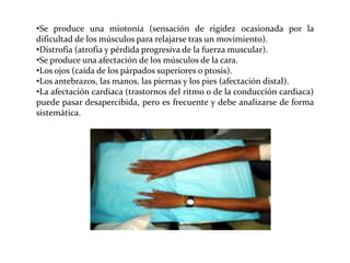 •Se produce una miotonía (sensación de rigidez ocasionada por la
dificultad de los músculos para relajarse tras un movimiento).
•Distrofia (atrofia y pérdida progresiva de la fuerza muscular).
•Se produce una afectación de los músculos de la cara.
•Los ojos (caída de los párpados superiores o ptosis).
•Los antebrazos, las manos, las piernas y los pies (afectación distal).
•La afectación cardiaca (trastornos del ritmo o de la conducción cardiaca)
puede pasar desapercibida, pero es frecuente y debe analizarse de forma
sistemática.

 