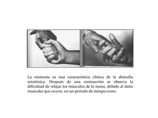 La miotonía es una característica clínica de la distrofia
miotónica. Después de una contracción se observa la
dificultad de relajar los músculos de la mano, debido al daño
muscular que ocurre, en un periodo de tiempo corto.

 