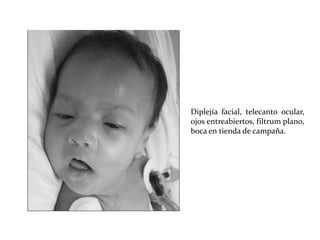 Diplejía facial, telecanto ocular,
ojos entreabiertos, filtrum plano,
boca en tienda de campaña.

 