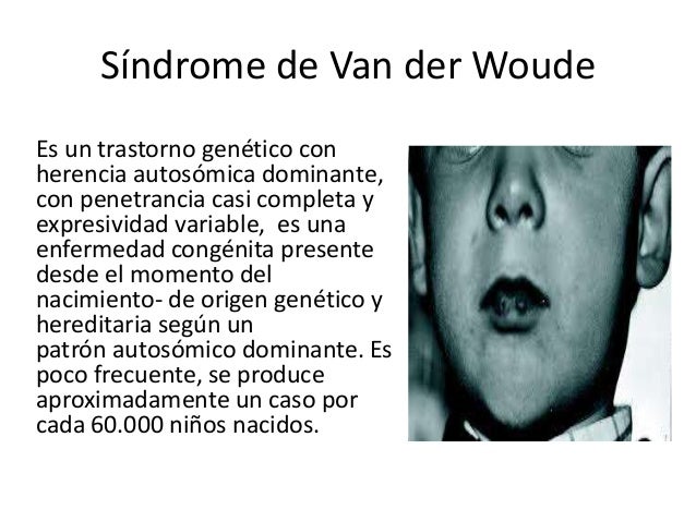 Síndrome de van der woude