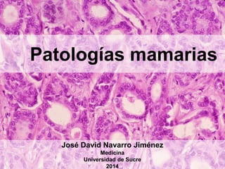 Patologías mamarias
José David Navarro Jiménez
Medicina
Universidad de Sucre
2014
 
