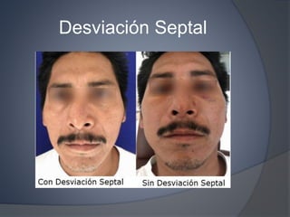 Desviación Septal
 