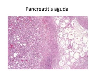 Pancreatitis aguda
 