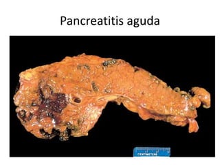 Pancreatitis aguda
 