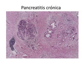 Pancreatitis crónica
 