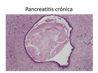 Pancreatitis crónica
 