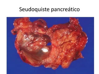 Seudoquiste pancreático
 