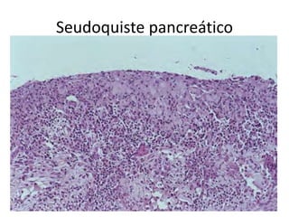 Seudoquiste pancreático
 