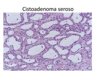 Cistoadenoma seroso
 
