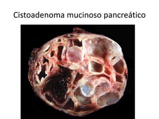 Cistoadenoma mucinoso pancreático
 
