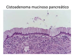 Cistoadenoma mucinoso pancreático
 
