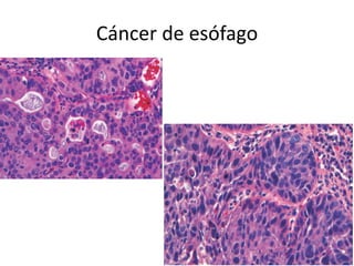 Cáncer de esófago
 