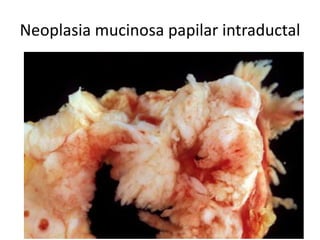 Neoplasia mucinosa papilar intraductal
 