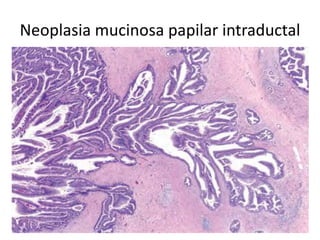 Neoplasia mucinosa papilar intraductal
 