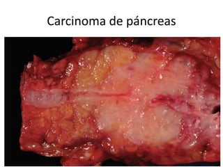 Carcinoma de páncreas
 