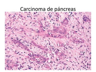 Carcinoma de páncreas
 