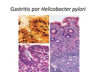 Gastritis por Helicobacter pylori
 