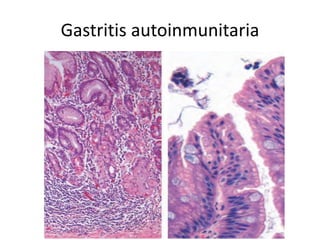 Gastritis autoinmunitaria
 