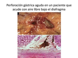 Perforación gástrica aguda en un paciente que
acude con aire libre bajo el diafragma
 