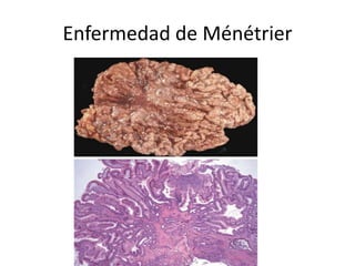 Enfermedad de Ménétrier
 