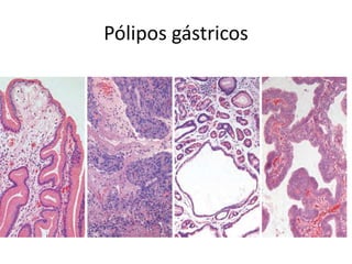Pólipos gástricos
 