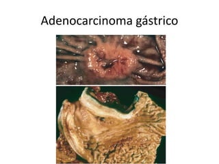 Adenocarcinoma gástrico
 