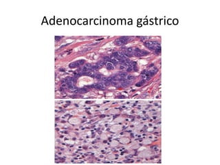 Adenocarcinoma gástrico
 