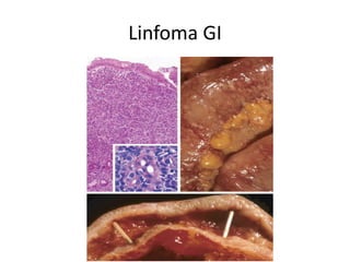 Linfoma GI
 