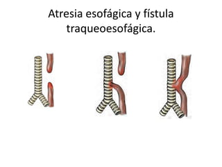 Atresia esofágica y fístula
traqueoesofágica.
 