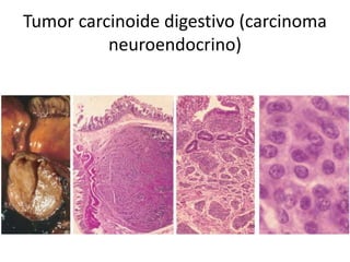 Tumor carcinoide digestivo (carcinoma
neuroendocrino)
 