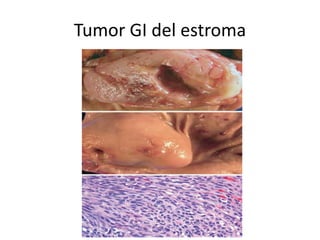 Tumor GI del estroma
 